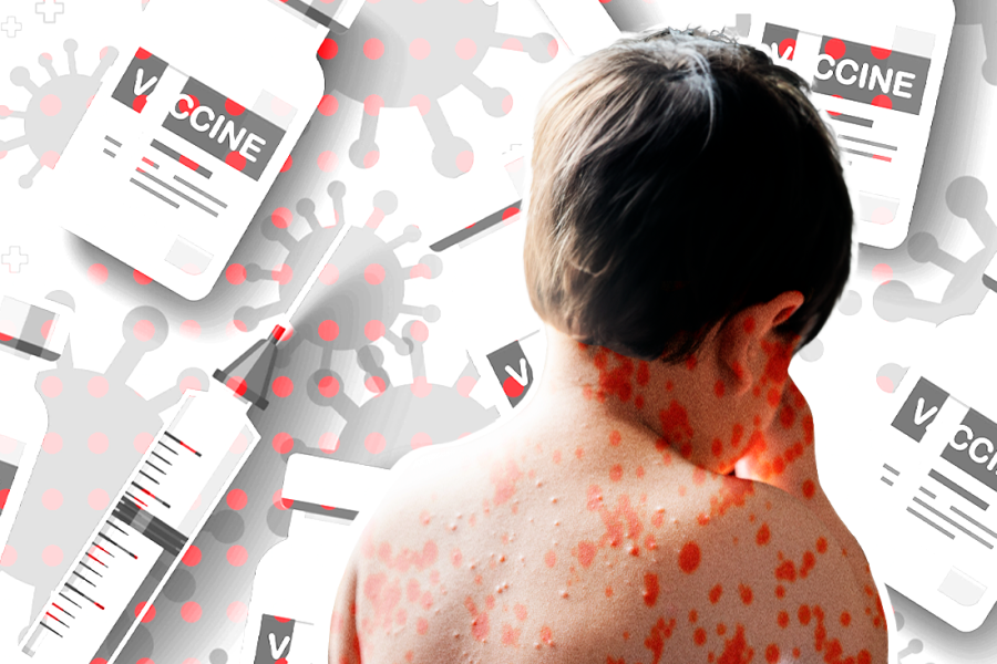 Niño con sarampión